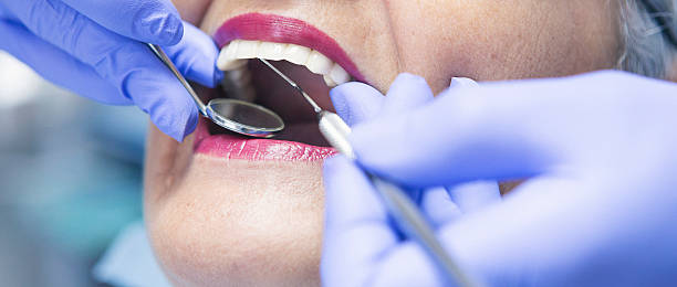 Best Knocked-Out Tooth (Avulsed Tooth) Treatment in Clinton, WI